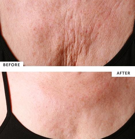 Silcskin Decollett Gel Pads - Skin & Brows by Tina