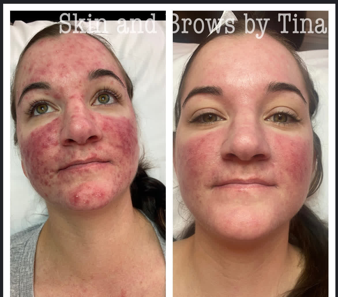 Before and after, side by side: active raised breakouts with strong redness over both cheeks and chin; after treatment the raised breakouts have largely cleared and the texture looks smoother, with redness reduced but still clearly visible.