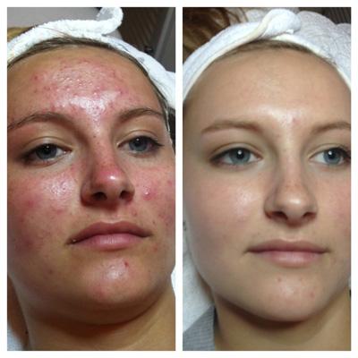 Before and after, side by side: scattered breakouts and irritated red patches across the forehead, cheeks and chin; after a series of visits the skin is clear and smooth with an even tone.