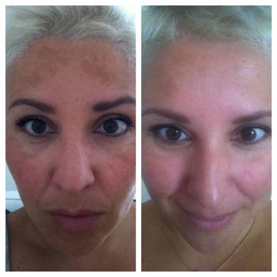 Before and after, side by side: patches of darker pigmentation across the forehead and cheeks; after treatment the pigmentation has faded and the skin tone looks even and brighter.