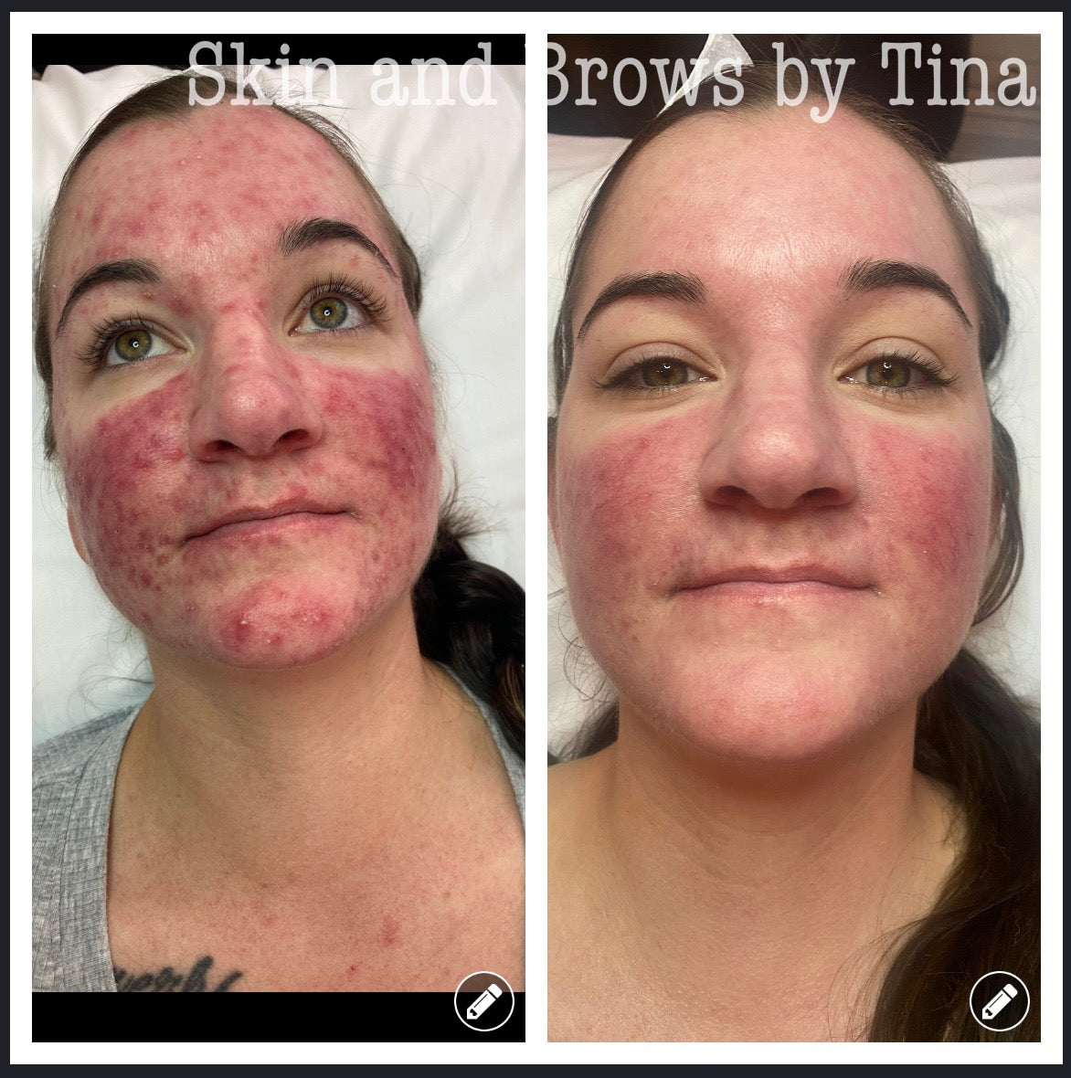 Before and after, side by side: severe inflamed acne with raised breakouts and deep redness across the cheeks, chin and forehead; after a series of visits the raised breakouts have largely cleared and the skin looks smoother, though noticeable redness remains across the cheeks and nose.